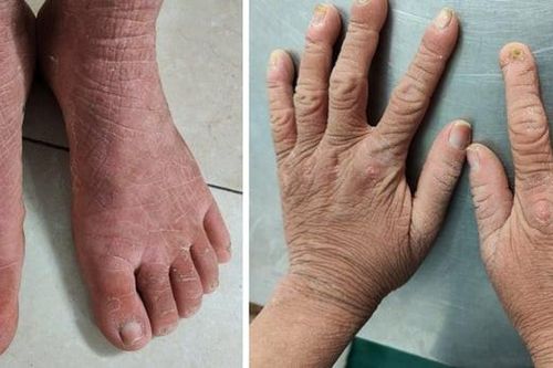 Căn bệnh hiếm gặp 'triệu người có một' khiến cô gái có vẻ ngoài già nua