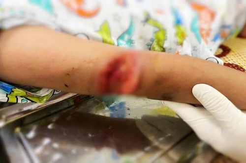 Bé gái 7 tuổi bị chó dữ cắn với nhiều vết thương phức tạp