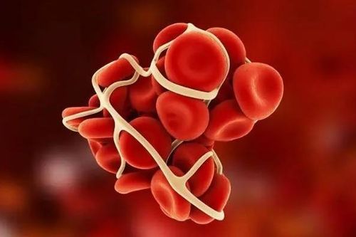 Những người dễ mắc chứng bệnh cục máu đông, phòng ngừa thế nào?
