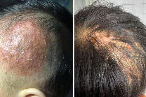 Lây nấm từ chó mèo, bé trai 9 tuổi đầu lở loét