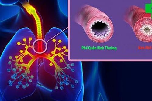 Ngày Hen toàn cầu 7/5 - Chủ động phòng bệnh hen phế quản tái phát