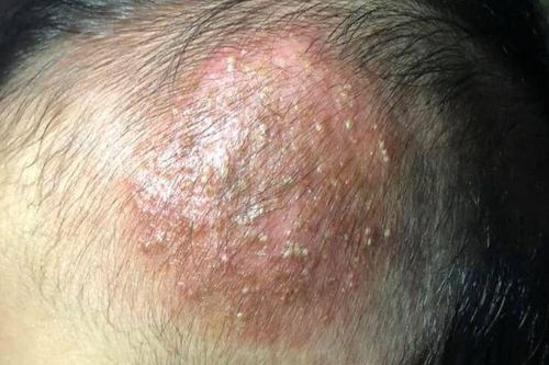 Trẻ nhiễm nấm tổ ong da đầu do lây từ chó mèo
