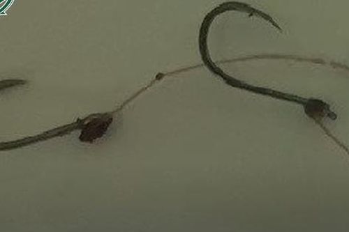 Lưỡi câu mắc kẹt ở thực quản bệnh nhi 13 tuổi
