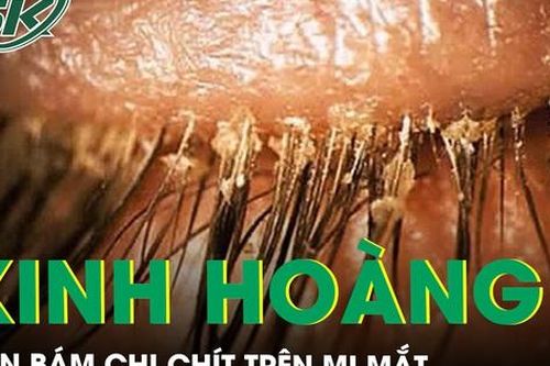 Kinh hoàng bé 5 tuổi bị rận bám chi chít trên mi mắt