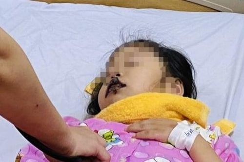 Bé gái 5 tuổi uống nhầm hóa chất thí nghiệm