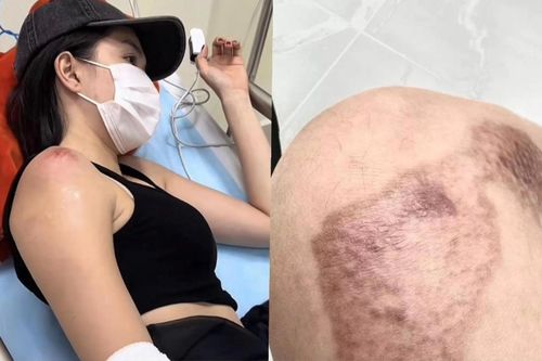 Ngọc Trinh tiết lộ số tiền điều trị chấn thương do tai nạn mô tô