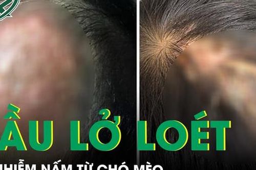 Đầu lở loét chảy dịch do nhiễm nấm từ chó mèo