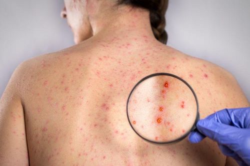 Khay thử phát hiện nhanh virus rubella