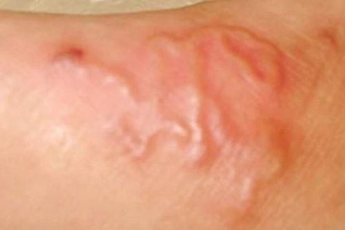 Mỗi năm khoảng 20.000 người ở nước ta phải điều trị do nhiễm giun sán lây từ 'thú cưng'