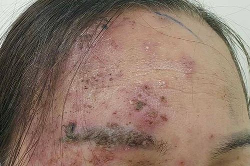 Biến chứng nặng vì tự điều trị bệnh 'giời leo' bằng đắp lá cây và 'đi phán'