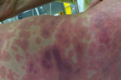 Hà Nội ghi nhận ca viêm não mô cầu đầu tiên