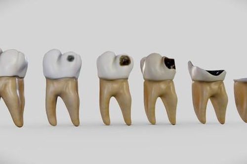 Sâu răng: Nguyên nhân, triệu chứng, điều trị và cách phòng ngừa
