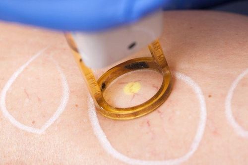 Những bước tiến trong điều trị suy giãn tĩnh mạch bằng laser xung dài