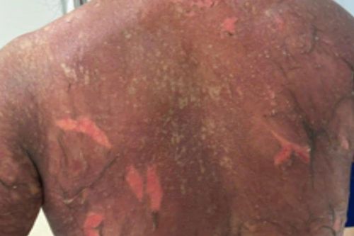 Biến chứng do lạm dụng thuốc đông y không rõ nguồn gốc
