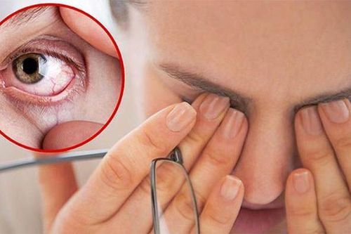 Nhiều người gặp tình trạng khô mắt do nằm điều hòa thường xuyên