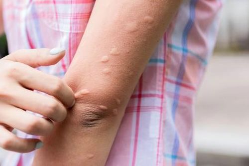 Cách điều trị mề đay và vết côn trùng cắn trong mùa hè nắng nóng