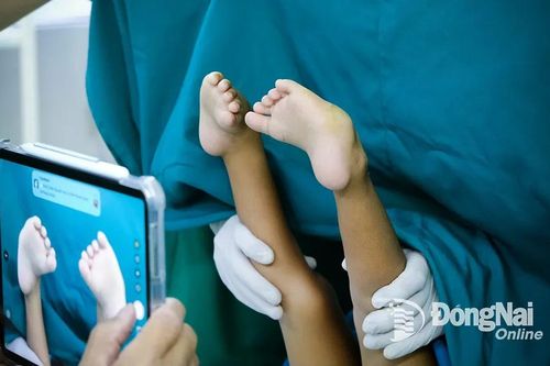 Mổ chỉnh hình bàn chân khoèo miễn phí cho 2 bệnh nhi