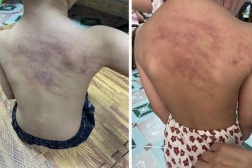 Hải Phòng: Phân công nhiệm vụ khác với giáo viên phụ trách lớp có trẻ bị bầm tím lưng khi đi học