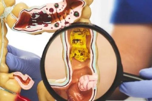 4 điều cần biết khi khám sàng lọc ung thư đại trực tràng