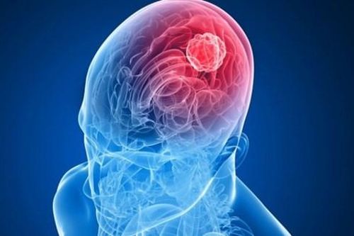 AI giúp phân loại khối u não chỉ trong vài giờ