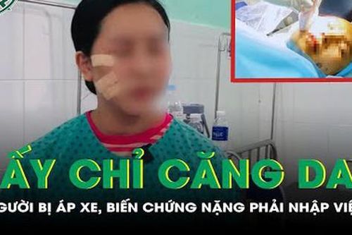 Cấy chỉ căng da, 2 người bị áp xe, biến chứng nặng