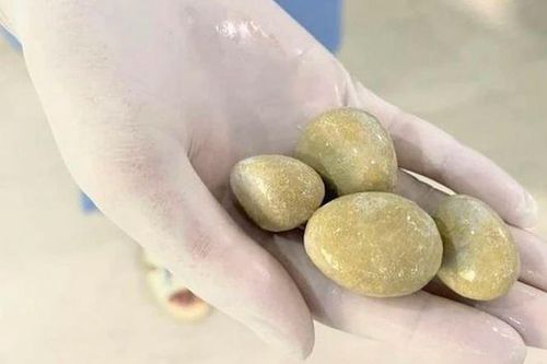 3 triệu chứng báo hiệu mắc sỏi bàng quang