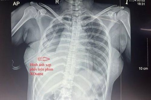 Cứu sống bệnh nhân đứt rời phế quản gốc bên phải nguy kịch