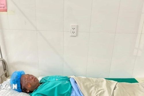 Yên Bái: Nổ khí gas do bất cẩn, 4 người trong một gia đình bị bỏng