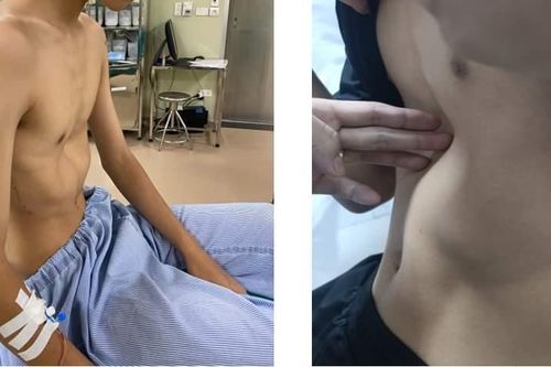 Bị lõm ngực bẩm sinh, bé trai khổ sở vì đau tức ngực, cong vẹo cột sống