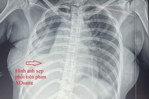 Người phụ nữ bị đứt phế quản do tai nạn giao thông
