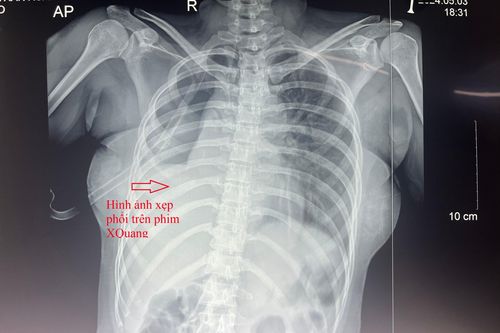 Các bác sĩ Cần Thơ cứu sống bệnh nhân bị tai nạn giao thông, đứt rời phế quản