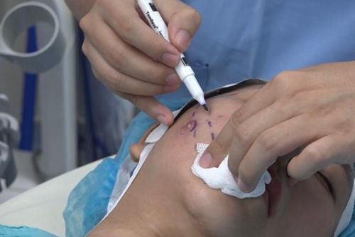 Nâng cơ da mặt bằng chỉ: Có thể gây biến chứng nguy hiểm