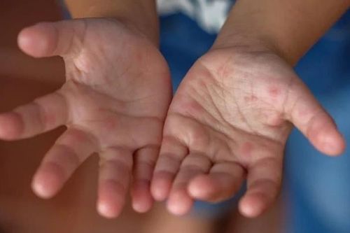 Hai bệnh truyền nhiễm đang gia tăng ở TP.HCM