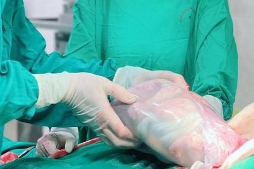 Em bé chào đời trong bọc điều hiếm gặp