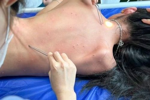 Ong đốt người đi đường phải cấp cứu tại Hải Phòng: Bác sĩ hướng dẫn cách xử lý tránh nguy hiểm