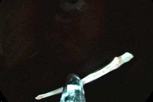 Hóc xương cá ngạnh dài 2,5cm