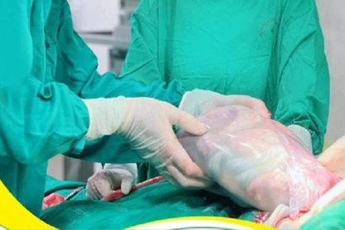 Thú vị em bé chào đời trong 'bọc điều'