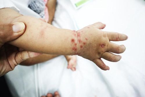 Toàn tỉnh ghi nhận gần 500 ca mắc tay chân miệng