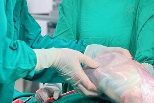 Bé gái sinh đôi chào đời trong 'bọc điều' hiếm gặp
