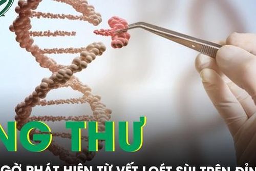 Đầu lở loét, chảy dịch, đi khám phát hiện ung thư
