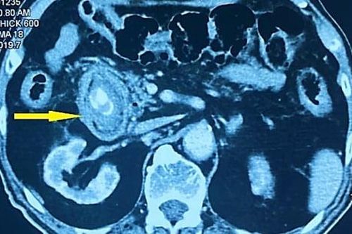 Sỏi túi mật 'đi lạc' vào tá tràng cụ ông 97 tuổi