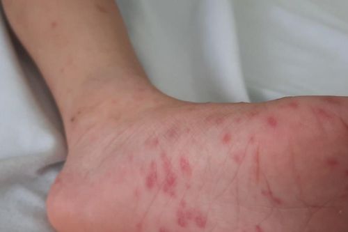 Hà Nội ghi nhận số ca mắc sốt xuất huyết giảm, tay chân miệng tăng