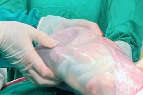 Bé sinh đôi ở Hưng Yên chào đời nằm nguyên trong 'bọc điều' hiếm gặp
