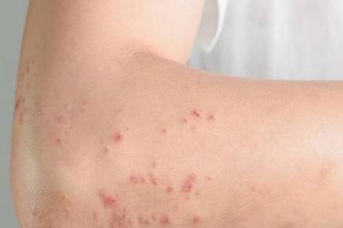 Ngứa da uống thuốc dị ứng không đỡ, cẩn thận với nhiễm giun đũa chó mèo