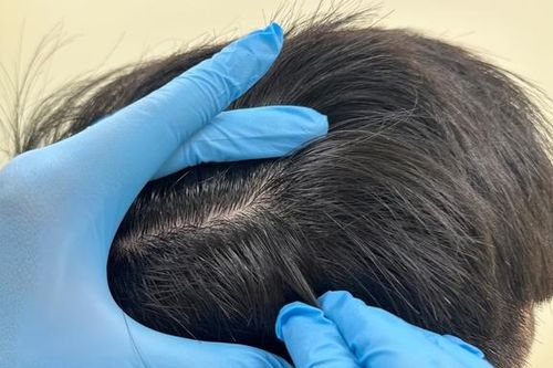 Thói quen nhổ tóc sâu, tóc bạc gây hại da đầu như thế nào?