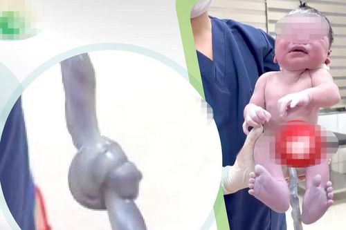 Nguy cơ trẻ tử vong do dây rốn thắt nút cao gấp 4 lần so với thai kỳ bình thường