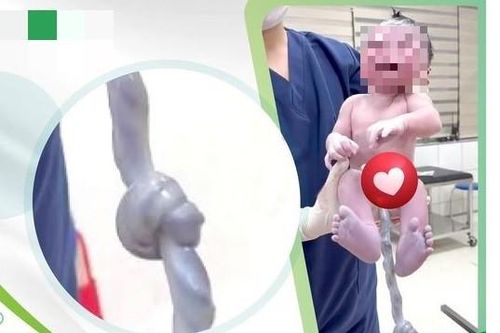 Bé bị dây rốn thắt nút chào đời bình an bằng sinh thường