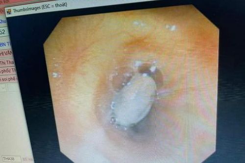 Hạt hồng xiêm nằm trong phổi cụ bà hơn 20 năm