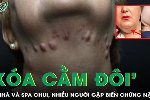 'Xóa cằm đôi' tại nhà và spa chui, nhiều người gặp biến chứng nặng