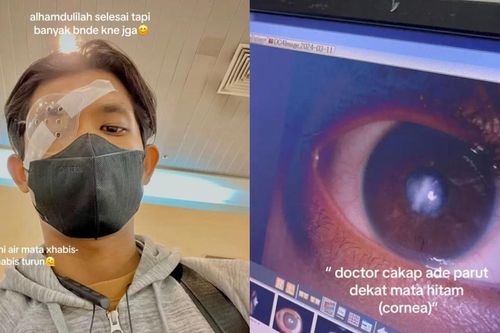 Thói quen tưởng vô hại khiến chàng trai trẻ ở Malaysia phải ghép giác mạc